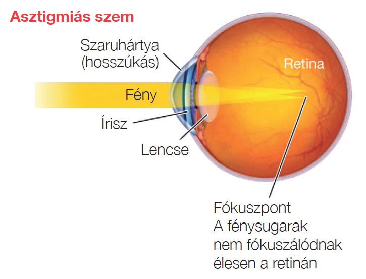 látástorna a szarvas szemek számára