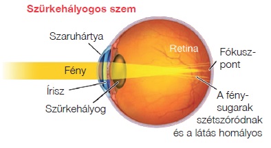 Javított látásmód a HOYA AF-1 aszférikus intraokuláris lencsével szürkehályog műtét után